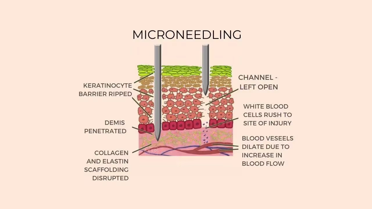 Microneedling