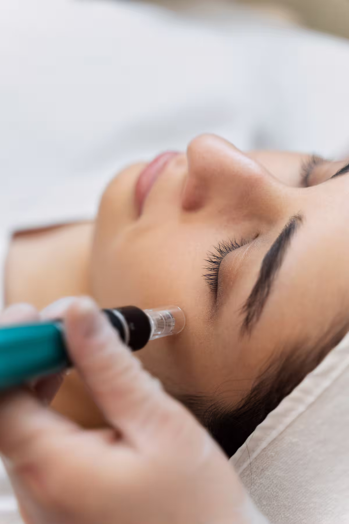 Microneedling 1