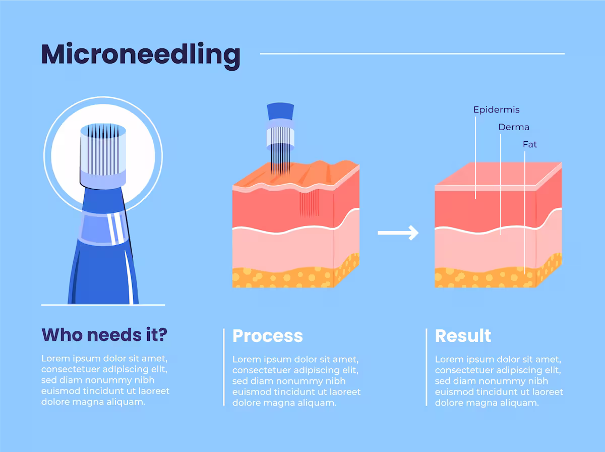 Microneedling 2