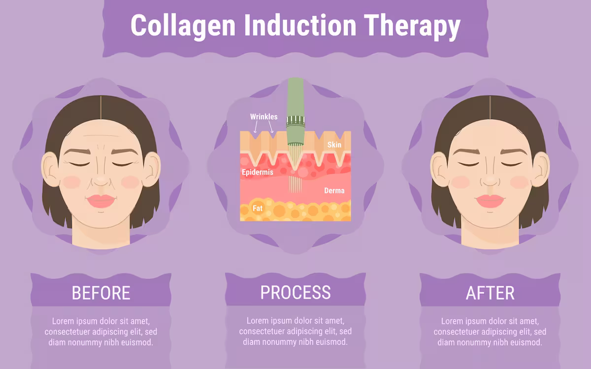 Microneedling 3